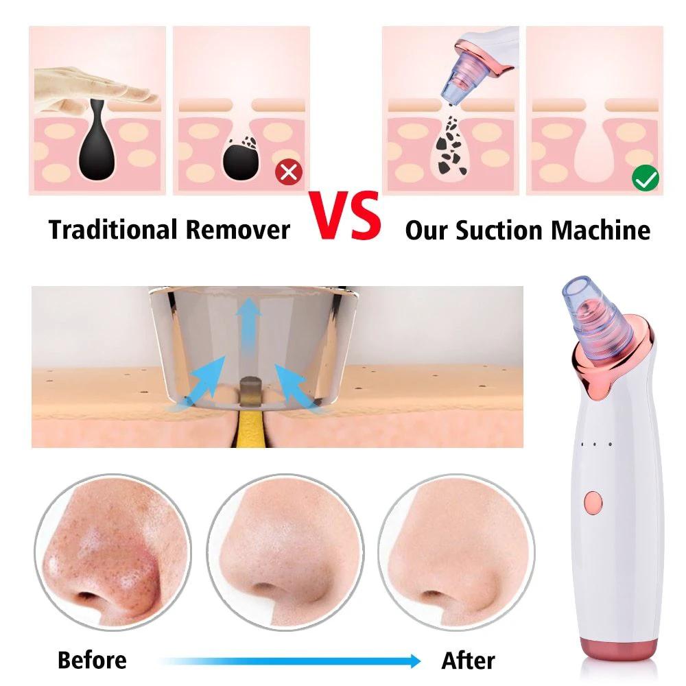 Blackhead Instrument Electric Suction Facial Washing Instrument Beauty Acne Cleaning Blackhead Suction Instrument by GJG Denim